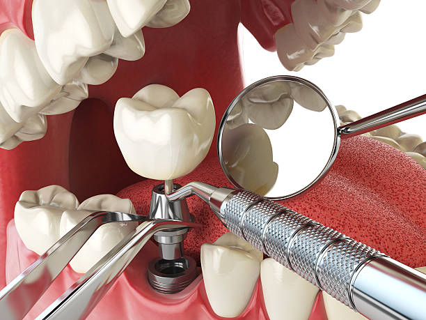 Best Emergency Tooth Extraction in Keewatin, MN